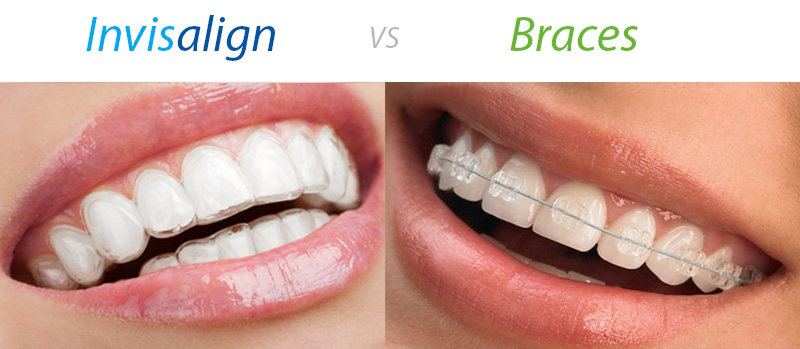 https://www.simplydental.co.nz/wp-content/uploads/Invisalign-vs-clear-ceramic-braces.jpg