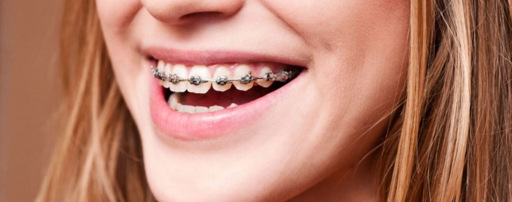 FastBraces and Invisalign: Which braces are best? - Simply Dental